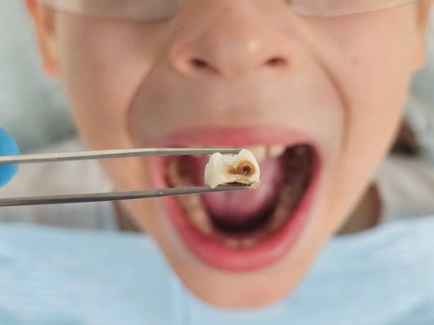 Best Emergency Treatment for Dental Infections or Abscesses in Wimberley, TX